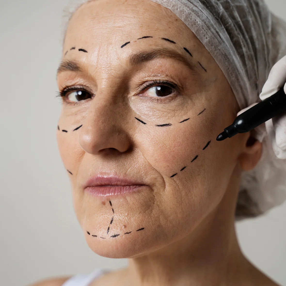 Antes harmonização facial