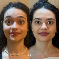 Botox Full Face com harmonização facial