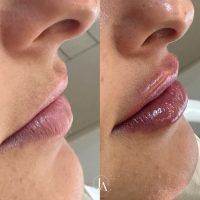 Preenchimento labial com harmonização facial