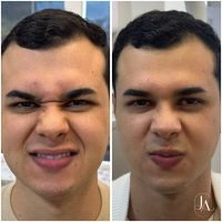 Botox Terço Superior com harmonização facial