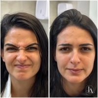 Botox Terço Superior com harmonização facial