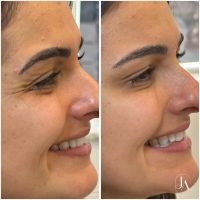 Botox Terço Superior com harmonização facial