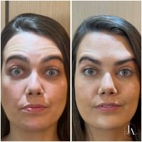 Botox Terço Superior com harmonização facial