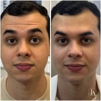 Botox Terço Superior com harmonização facial