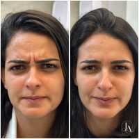 Botox Terço Superior com harmonização facial